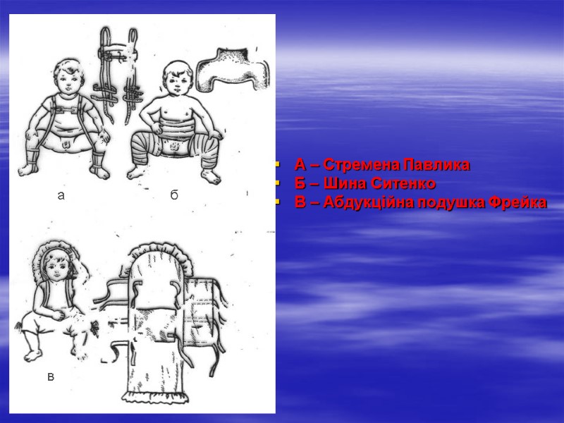 А – Стремена Павлика Б – Шина Ситенко В – Абдукційна подушка Фрейка а